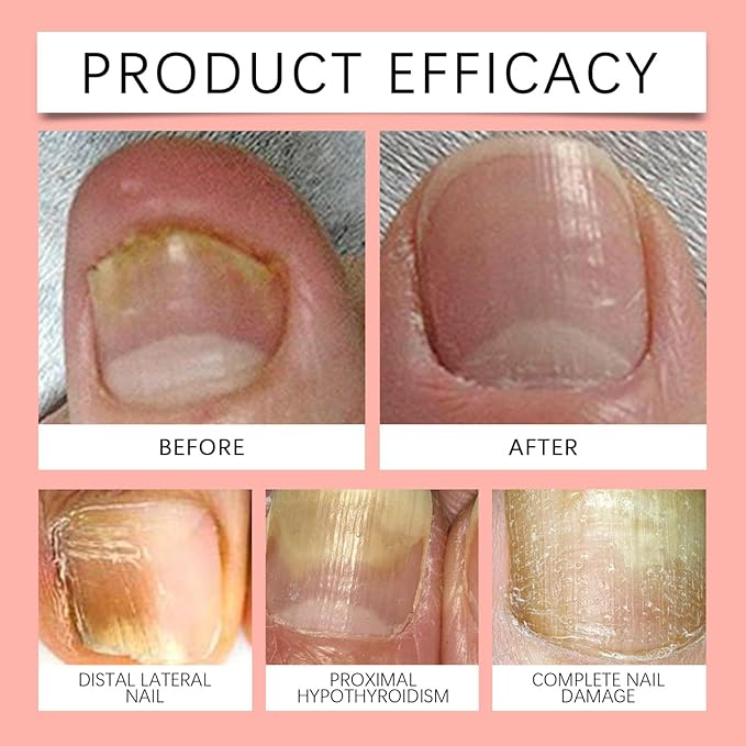 Revive Fungus Nail Patch 10 piece - Image 6